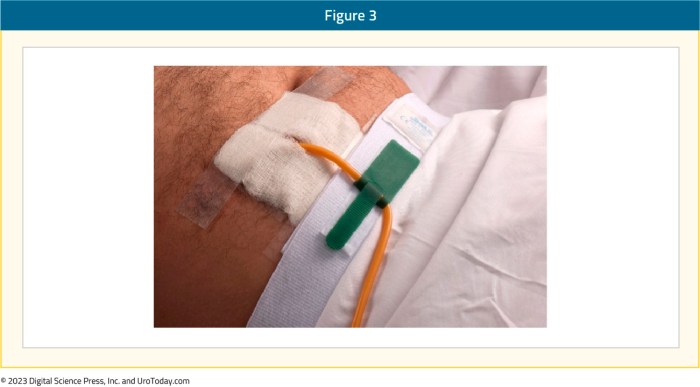 Can lpn change suprapubic catheter